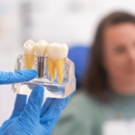 Why Choose London for Your Dental Implants? Expert Insights